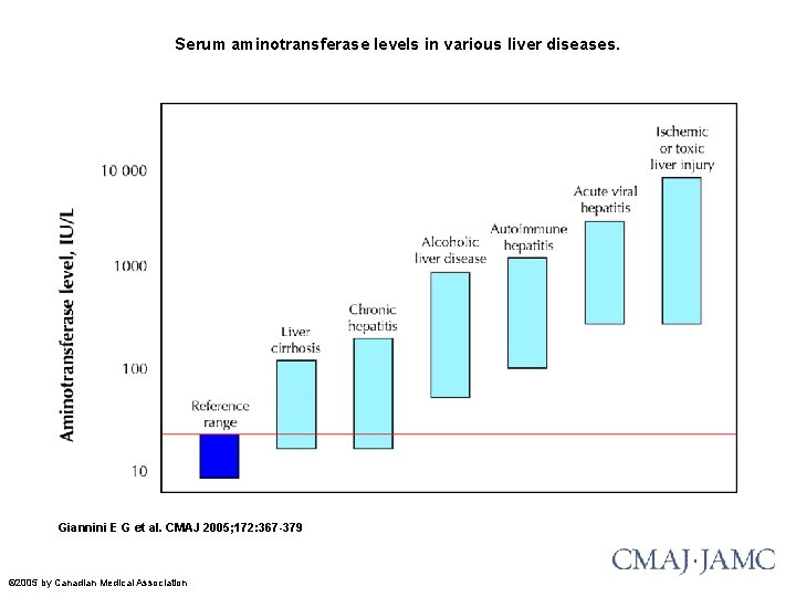 Serum aminotransferase levels in various liver diseases. Giannini E G et al. CMAJ 2005;