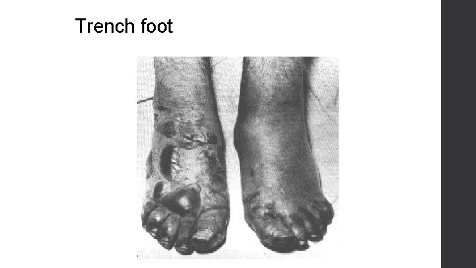 Trench foot 