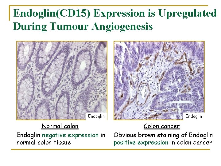 Endoglin(CD 15) Expression is Upregulated During Tumour Angiogenesis Endoglin Normal colon Endoglin negative expression