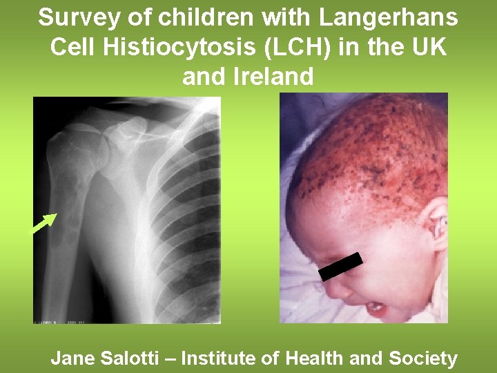 Survey of children with Langerhans Cell Histiocytosis (LCH) in the UK and Ireland Jane