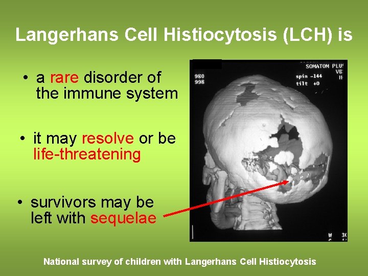Langerhans Cell Histiocytosis (LCH) is • a rare disorder of the immune system •