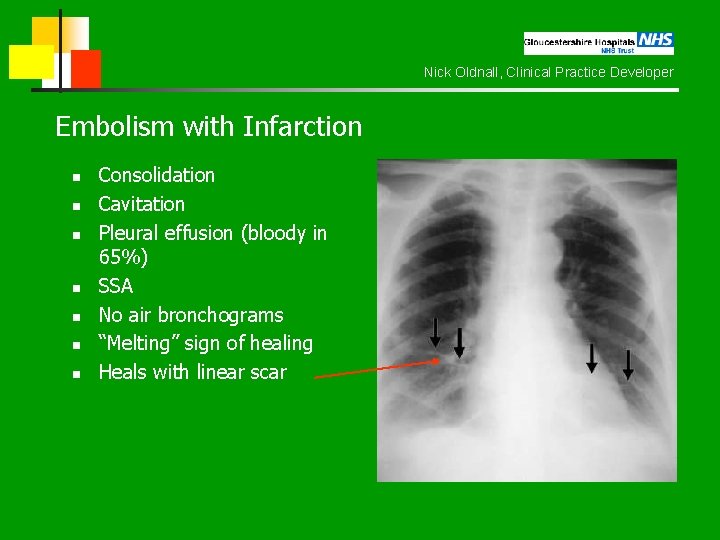 Nick Oldnall, Clinical Practice Developer Embolism with Infarction n n n Consolidation Cavitation Pleural