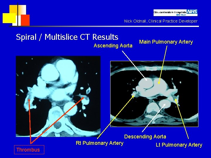 Nick Oldnall, Clinical Practice Developer Spiral / Multislice CT Results Ascending Aorta Main Pulmonary