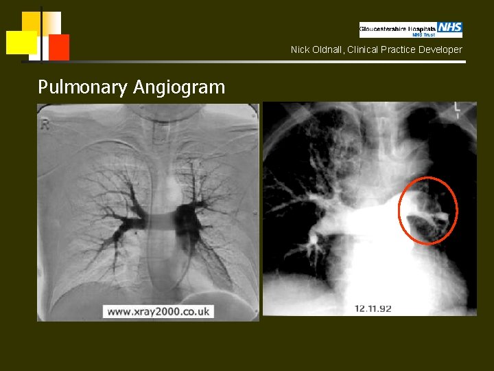 Nick Oldnall, Clinical Practice Developer Pulmonary Angiogram 