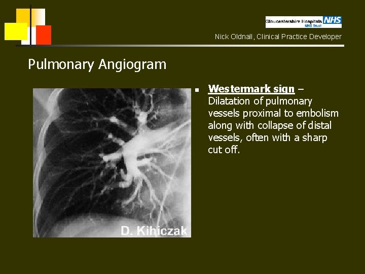 Nick Oldnall, Clinical Practice Developer Pulmonary Angiogram n Westermark sign – Dilatation of pulmonary