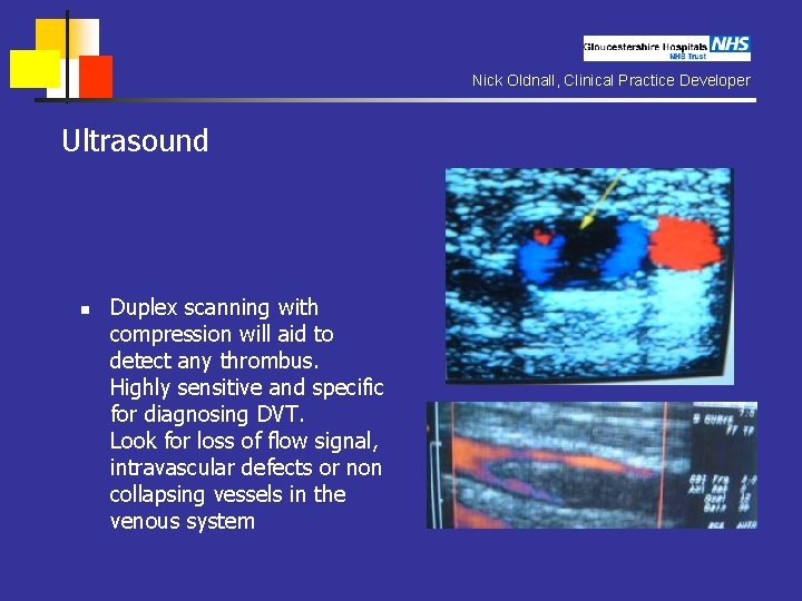 Nick Oldnall, Clinical Practice Developer Ultrasound n Duplex scanning with compression will aid to