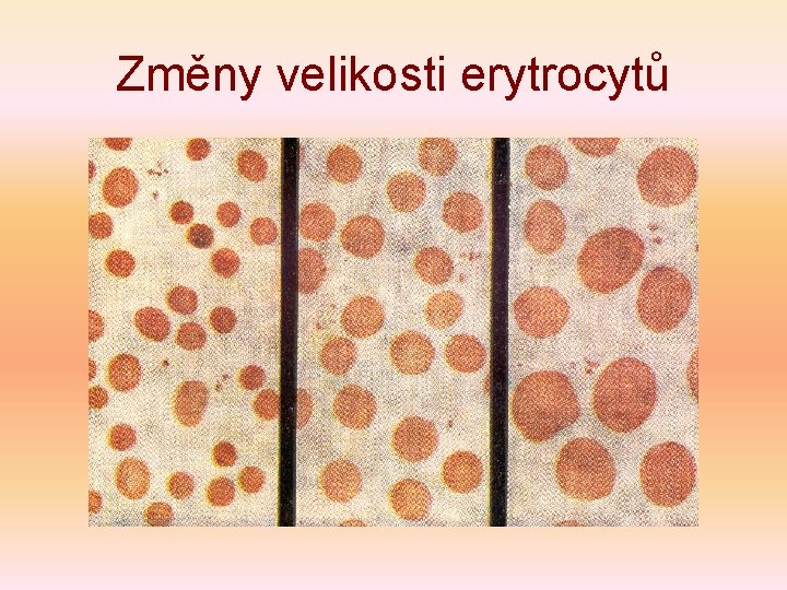 Změny velikosti erytrocytů 