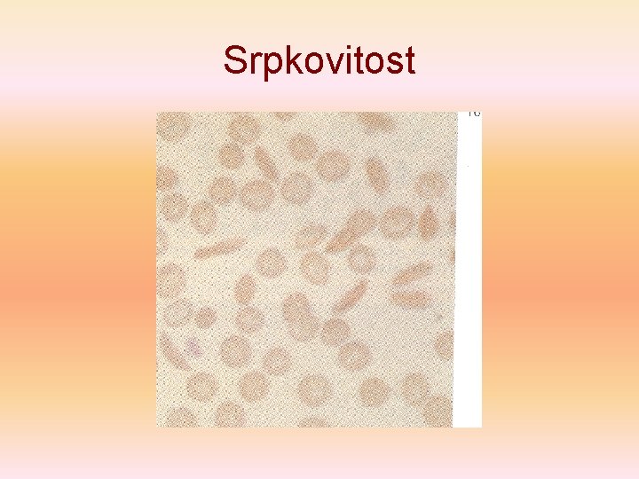 Srpkovitost 