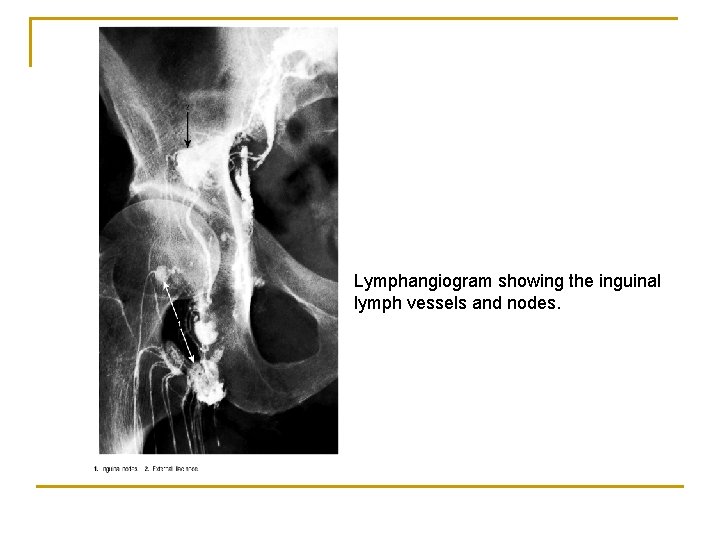 Lymphangiogram showing the inguinal lymph vessels and nodes. 