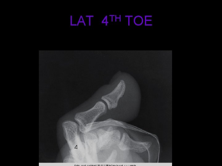 LAT 4 TH TOE 17 