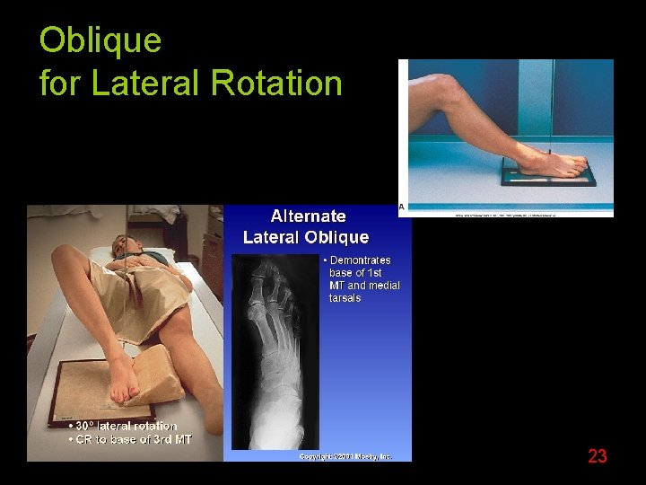 Oblique for Lateral Rotation 23 