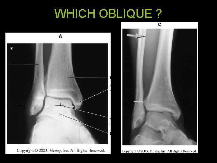 WHICH OBLIQUE ? 55 