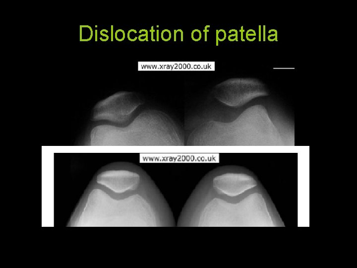 Dislocation of patella 86 