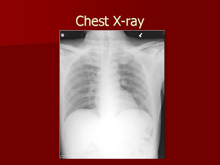 Chest X-ray 