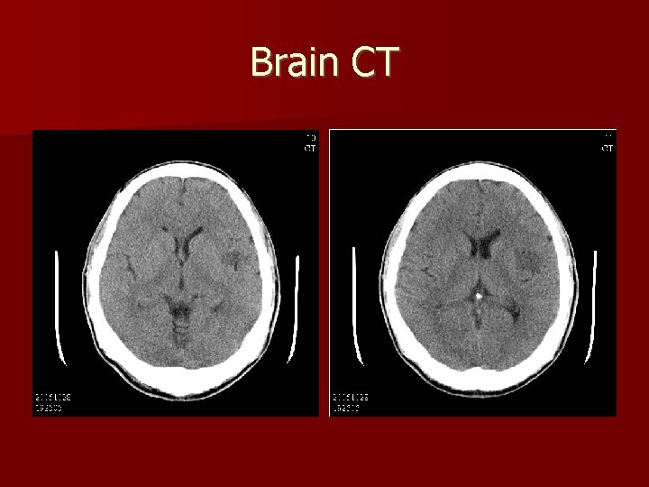 Brain CT 