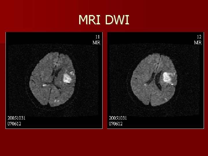 MRI DWI 