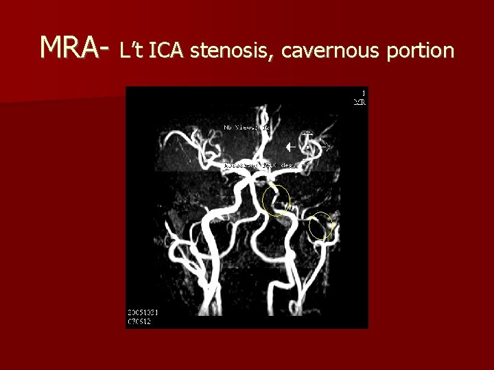 MRA- L’t ICA stenosis, cavernous portion 