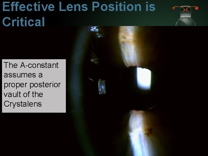 Effective Lens Position is Critical The A-constant assumes a proper posterior vault of the