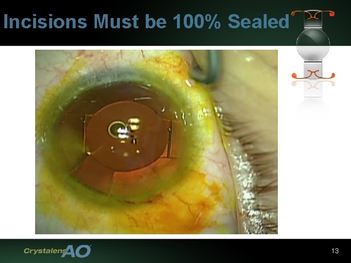 Incisions Must be 100% Sealed 13 