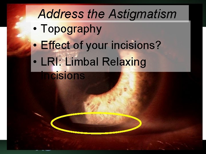 Address the Astigmatism • Topography • Effect of your incisions? • LRI: Limbal Relaxing