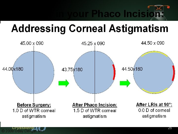 Factor in your Phaco Incision: Figure 1 © 2009 Uday Devgan MD 25 
