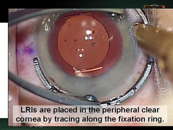 LRIs are placed in the peripheral clear cornea by tracing along the fixation ring.