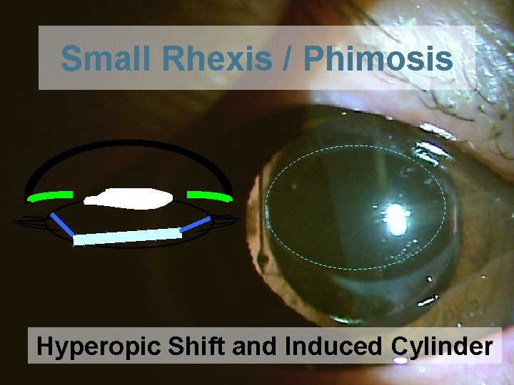 Small Rhexis / Phimosis Hyperopic Shift and Induced Cylinder 35 