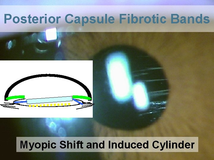 Posterior Capsule Fibrotic Bands Myopic Shift and Induced Cylinder 36 
