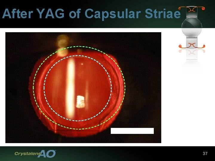 After YAG of Capsular Striae 37 