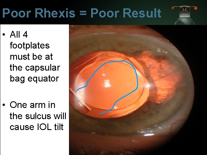 Poor Rhexis = Poor Result • All 4 footplates must be at the capsular