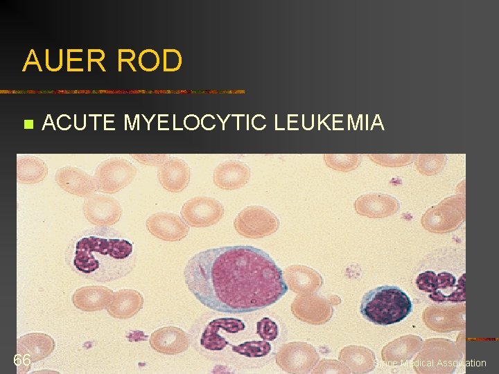 AUER ROD n 66 ACUTE MYELOCYTIC LEUKEMIA Sinoe Medical Association 