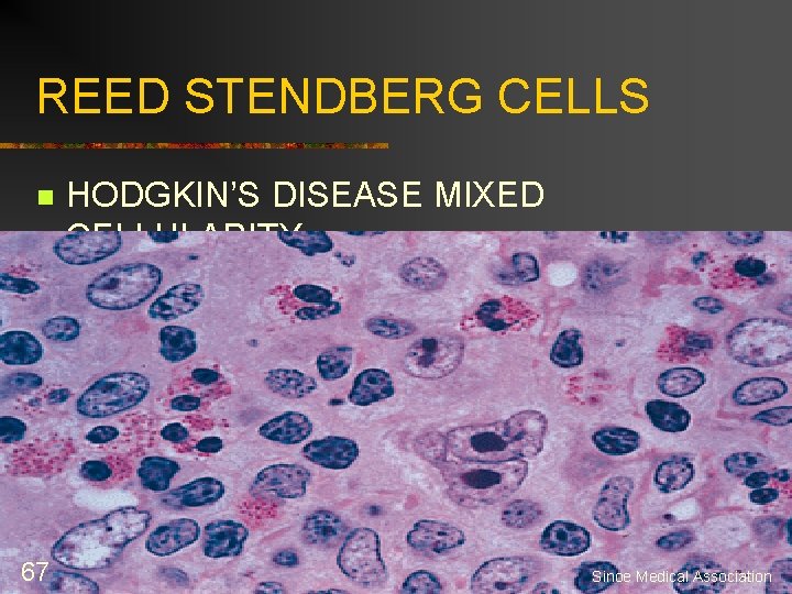 REED STENDBERG CELLS n 67 HODGKIN’S DISEASE MIXED CELLULARITY Sinoe Medical Association 