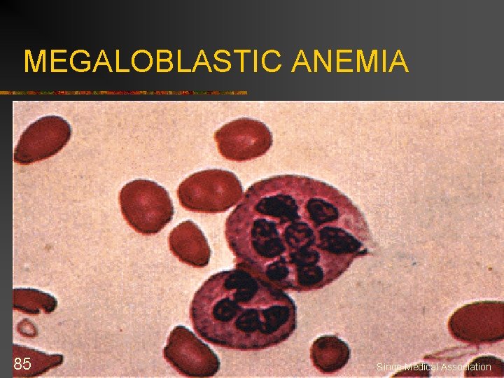 MEGALOBLASTIC ANEMIA 85 Sinoe Medical Association 