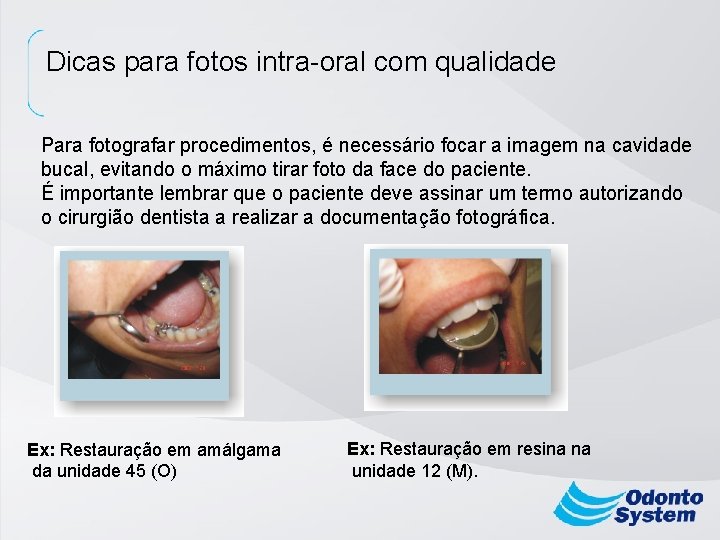 Dicas para fotos intra-oral com qualidade Para fotografar procedimentos, é necessário focar a imagem