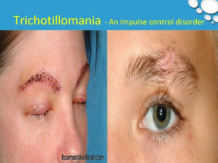 Trichotillomania - An impulse control disorder 