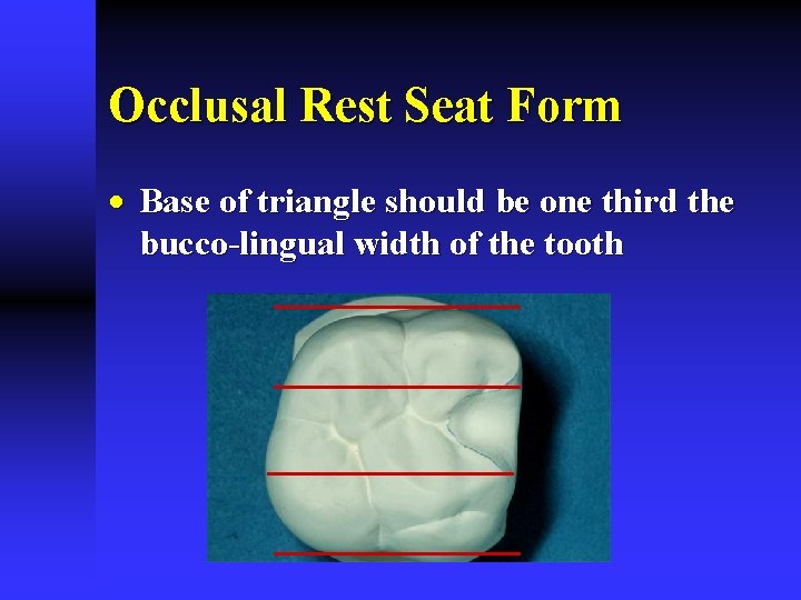 Occlusal Rest Seat Form · Base of triangle should be one third the bucco-lingual Occlusal Rest Seat Form · Base of triangle should be one third the bucco-lingual