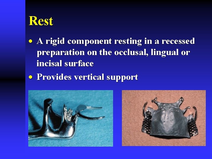 Rest · A rigid component resting in a recessed preparation on the occlusal, lingual Rest · A rigid component resting in a recessed preparation on the occlusal, lingual