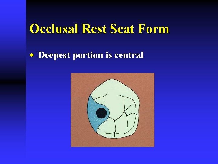 Occlusal Rest Seat Form · Deepest portion is central 