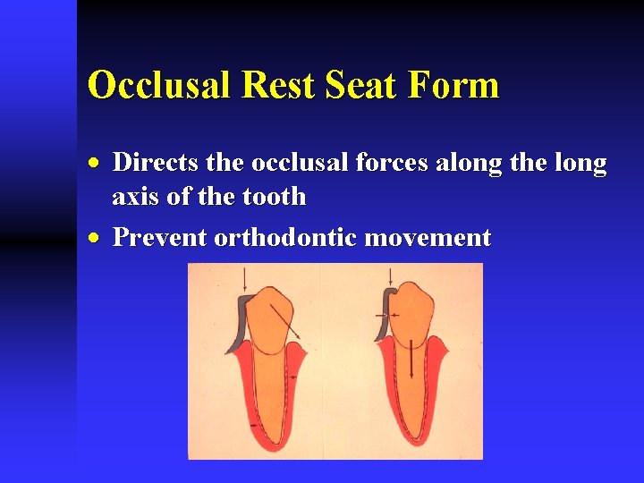 Occlusal Rest Seat Form · Directs the occlusal forces along the long axis of Occlusal Rest Seat Form · Directs the occlusal forces along the long axis of
