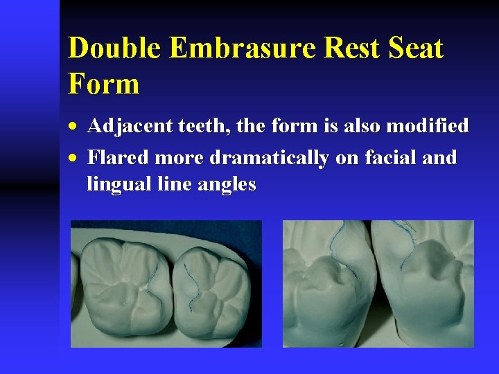 Double Embrasure Rest Seat Form · Adjacent teeth, the form is also modified ·