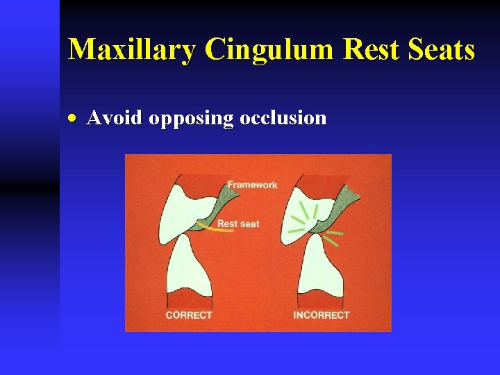 Maxillary Cingulum Rest Seats · Avoid opposing occlusion 