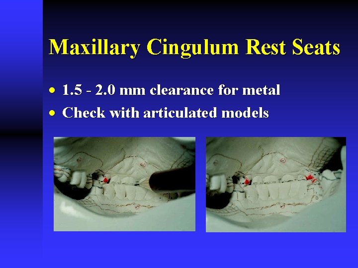 Maxillary Cingulum Rest Seats · 1. 5 - 2. 0 mm clearance for metal Maxillary Cingulum Rest Seats · 1. 5 - 2. 0 mm clearance for metal