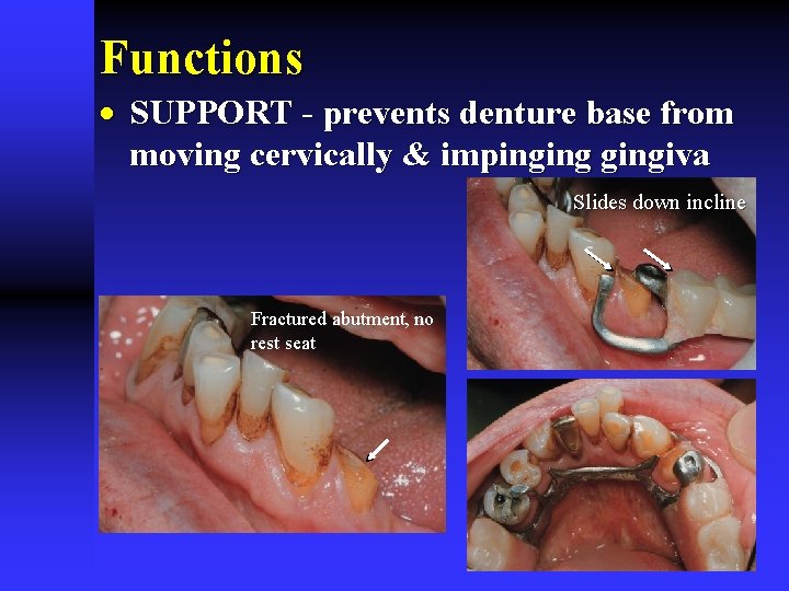 Functions · SUPPORT - prevents denture base from moving cervically & impingingiva Slides down Functions · SUPPORT - prevents denture base from moving cervically & impingingiva Slides down