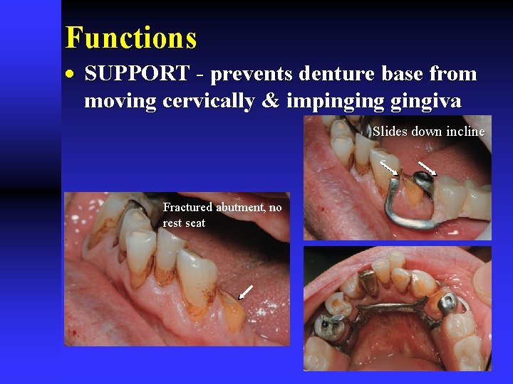 Functions · SUPPORT - prevents denture base from moving cervically & impingingiva Slides down