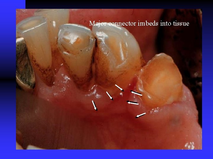 Major connector imbeds into tissue Major connector imbeds into tissue