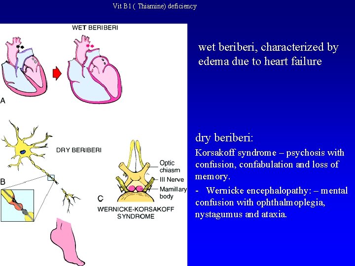 Vit B 1 ( Thiamine) deficiency wet beri, characterized by edema due to heart