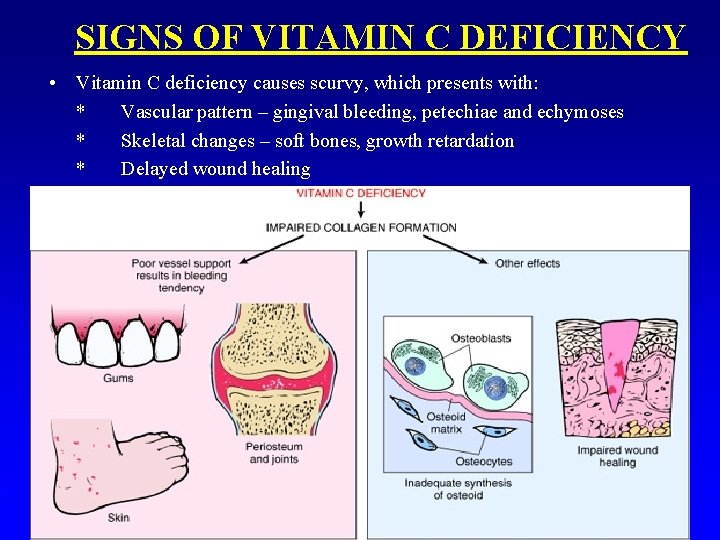 SIGNS OF VITAMIN C DEFICIENCY • Vitamin C deficiency causes scurvy, which presents with: