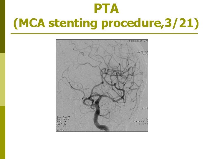 PTA (MCA stenting procedure, 3/21) 