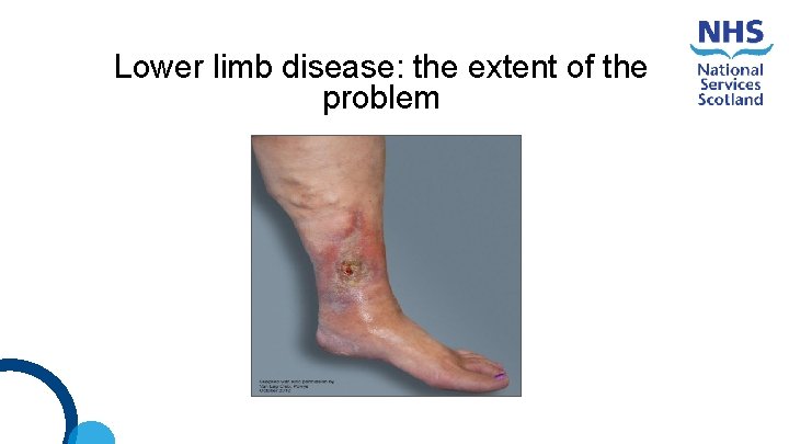 Lower limb disease: the extent of the problem 