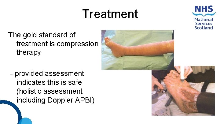 Treatment The gold standard of treatment is compression therapy - provided assessment indicates this